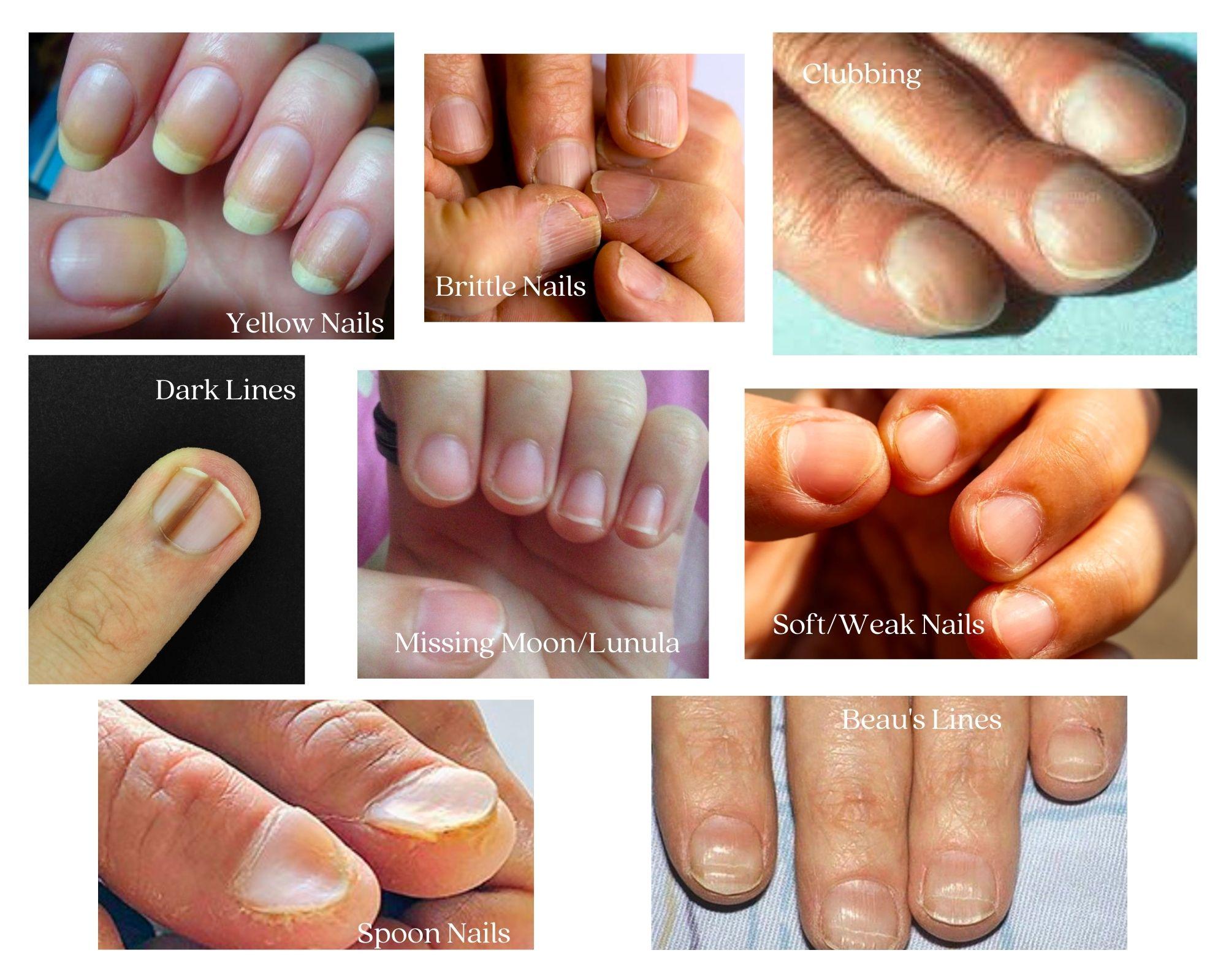 Home Remedies for Brittle Nails Caused by Nutritional Deficiencies - YouTube